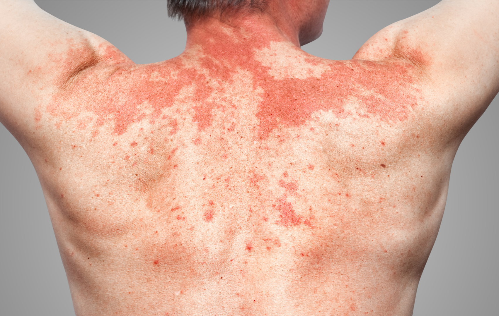 Allergies professionnelles : comment repérer les risques avant les premiers symptômes ?